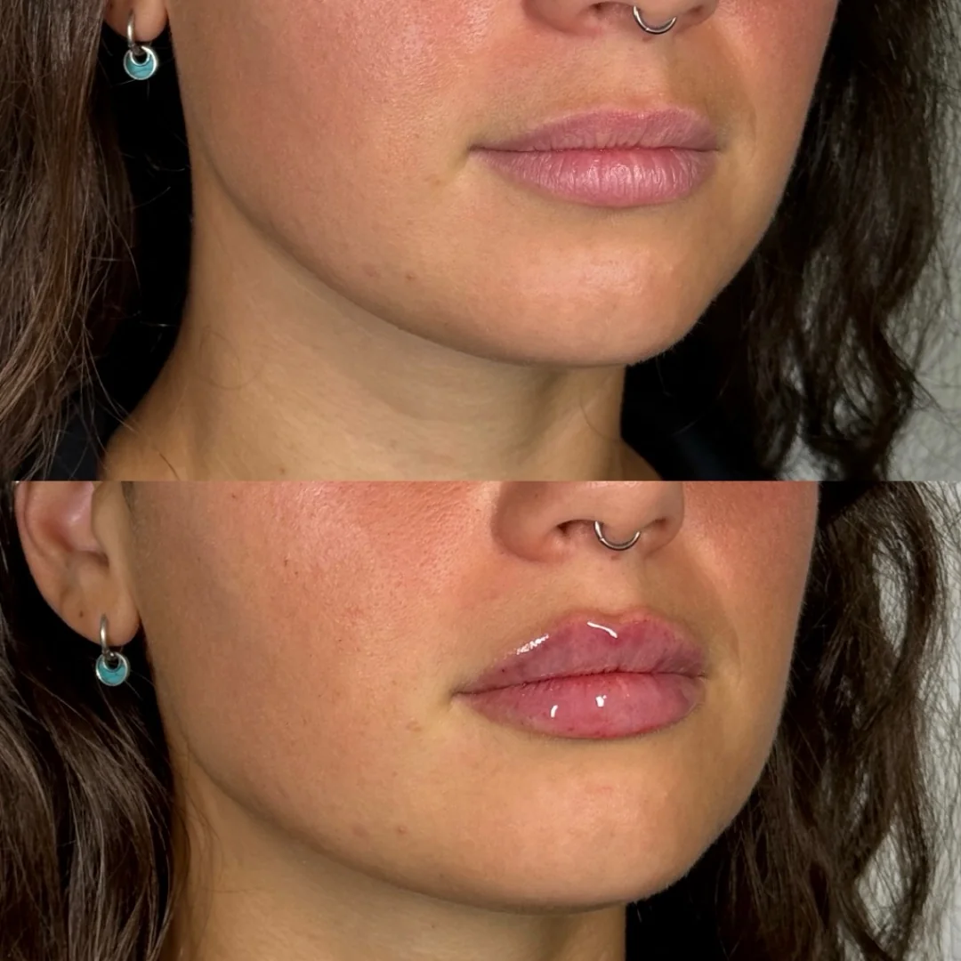 not-sure-i-really-got-1ml-injected-in-my-lips-before-after-v0-pmy7bzvdhzxc1 (1).webp